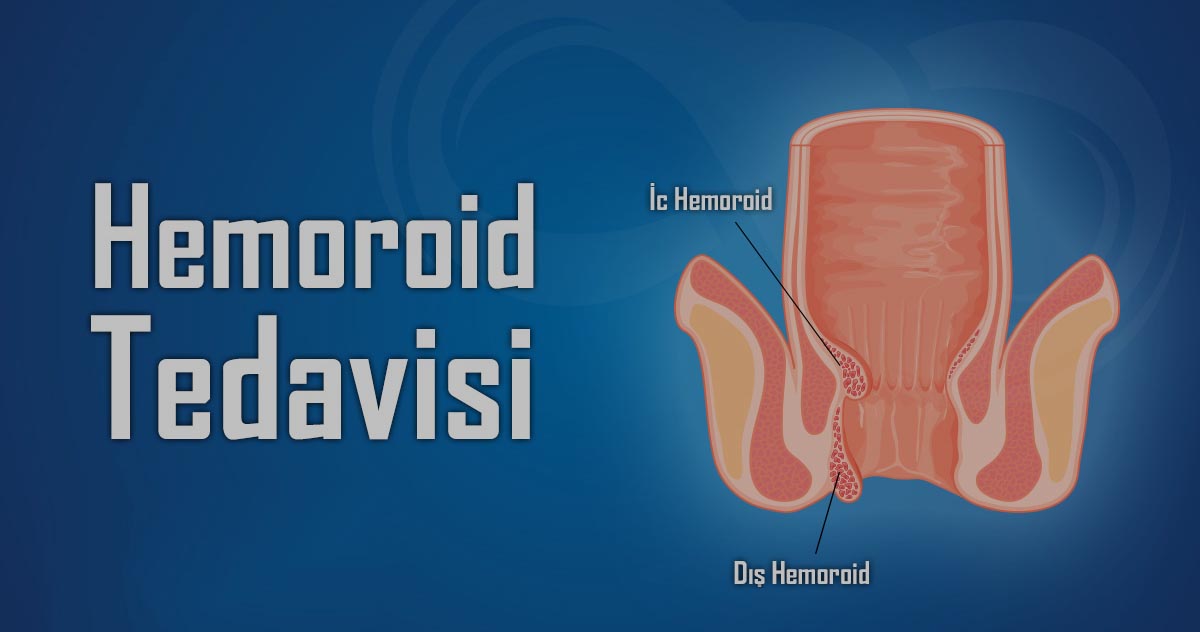 Hemoroid Tedavisi