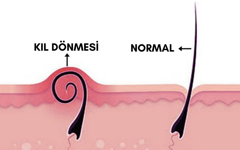 Kıl Dönmesi